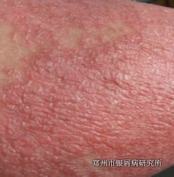 红皮型牛皮癣会不会传染