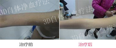 郑州市哪里治疗牛皮癣效果好