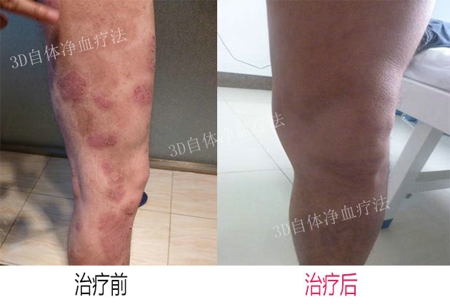 牛皮癣初期怎么办